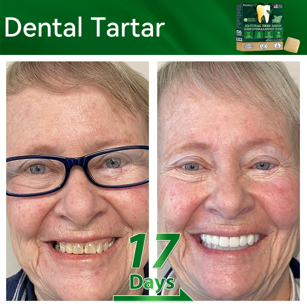 𝑂𝑓𝑓𝑖𝑐𝑖𝑎𝑙 𝑆𝑡𝑜𝑟𝑒👩‍⚕️🎁|𝐾𝑒𝑦𝑒𝑠𝑠® 𝑁𝑎𝑡𝑢𝑟𝑎𝑙 𝑇𝑟𝑒𝑒 𝑅𝑒𝑠𝑖𝑛 𝑅𝑒𝑚𝑖𝑛𝑒𝑟𝑎𝑙𝑖𝑧𝑖𝑛𝑔 𝐺𝑢𝑚🦷(Last 30 minutes of the limited-time offer!)