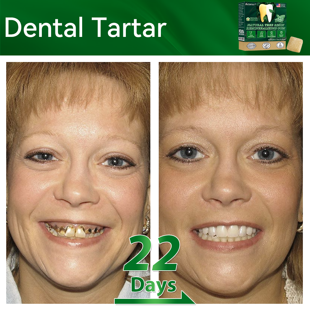 𝑂𝑓𝑓𝑖𝑐𝑖𝑎𝑙 𝑆𝑡𝑜𝑟𝑒👩‍⚕️🎁|𝐾𝑒𝑦𝑒𝑠𝑠® 𝑁𝑎𝑡𝑢𝑟𝑎𝑙 𝑇𝑟𝑒𝑒 𝑅𝑒𝑠𝑖𝑛 𝑅𝑒𝑚𝑖𝑛𝑒𝑟𝑎𝑙𝑖𝑧𝑖𝑛𝑔 𝐺𝑢𝑚🦷(Last 30 minutes of the limited-time offer!)